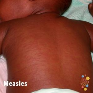 an image of the back of a young child with a rash
