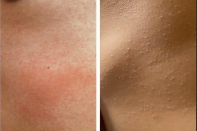 skin showing scarlet fever